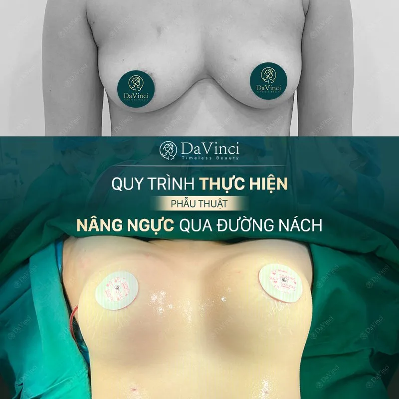 Nâng ngực đường nách và những điều bạn nên biết Nâng ngực đường nách và những điều bạn nên biết