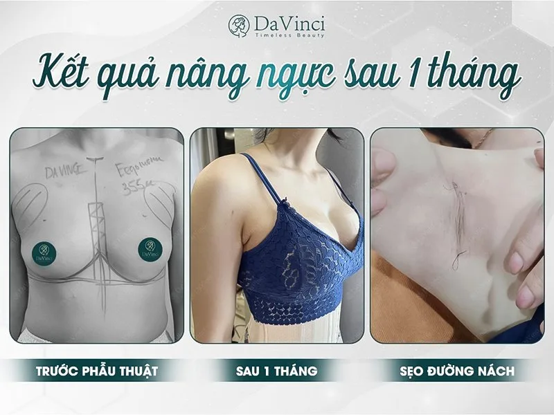 Nâng ngực đường nách và những điều bạn nên biết Nâng ngực đường nách và những điều bạn nên biết