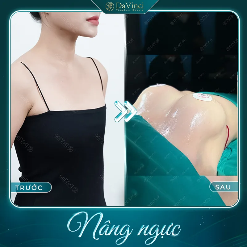 Sau khi nâng ngực phải kiêng ăn gì và kiêng trong bao lâu?
