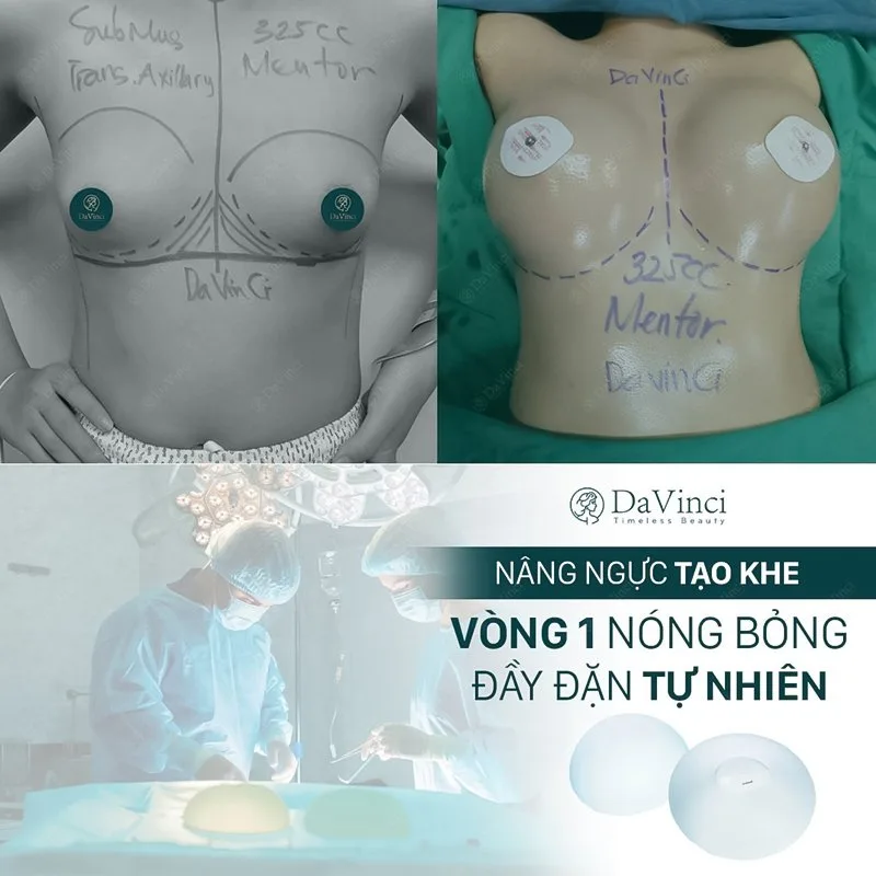 Phương pháp nâng ngực qua đường nào tốt nhất hiện nay? Phương pháp nâng ngực qua đường nào tốt nhất hiện nay?