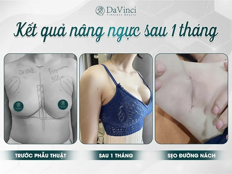 Phương pháp nâng ngực qua đường nào tốt nhất hiện nay? Phương pháp nâng ngực qua đường nào tốt nhất hiện nay?