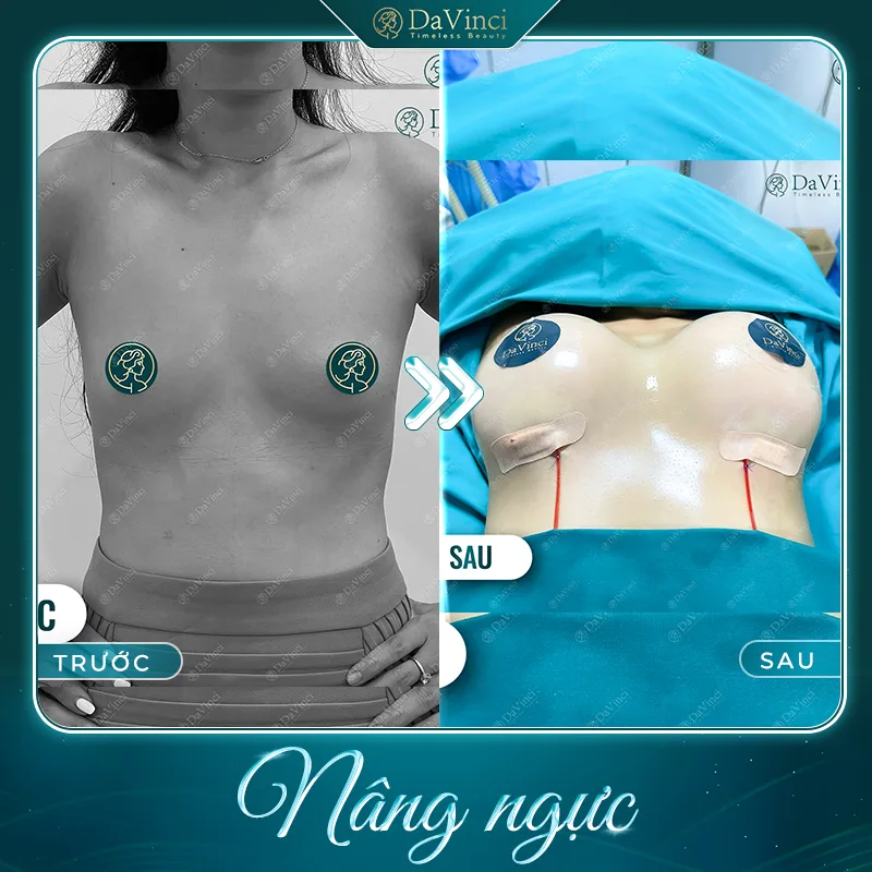 Nâng ngực xong có đau không? Lưu ý chăm sóc sau nâng ngực