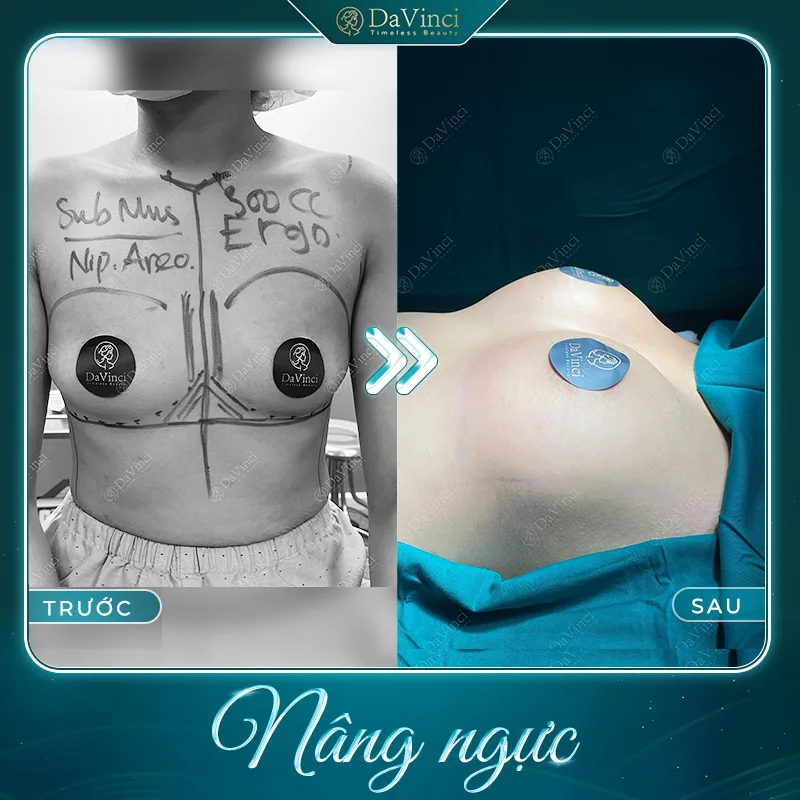 Top 3 loại túi nâng ngực tốt, an toàn và được ưa chuộng nhất hiện nay