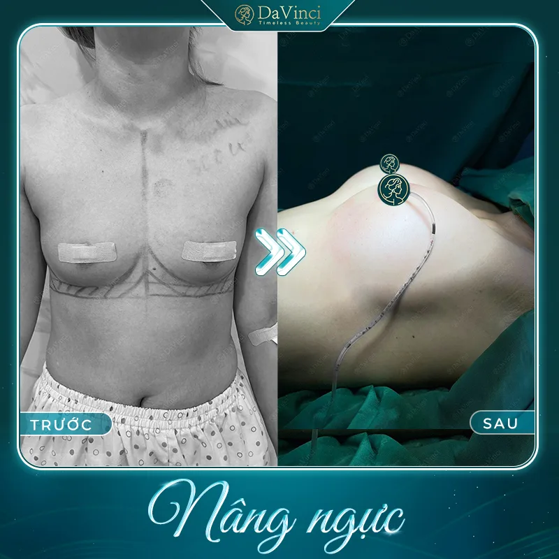 Túi ngực Motiva có tốt không? Giá bao nhiêu? Của nước nào? Túi ngực Motiva có tốt không? Giá bao nhiêu? Của nước nào?