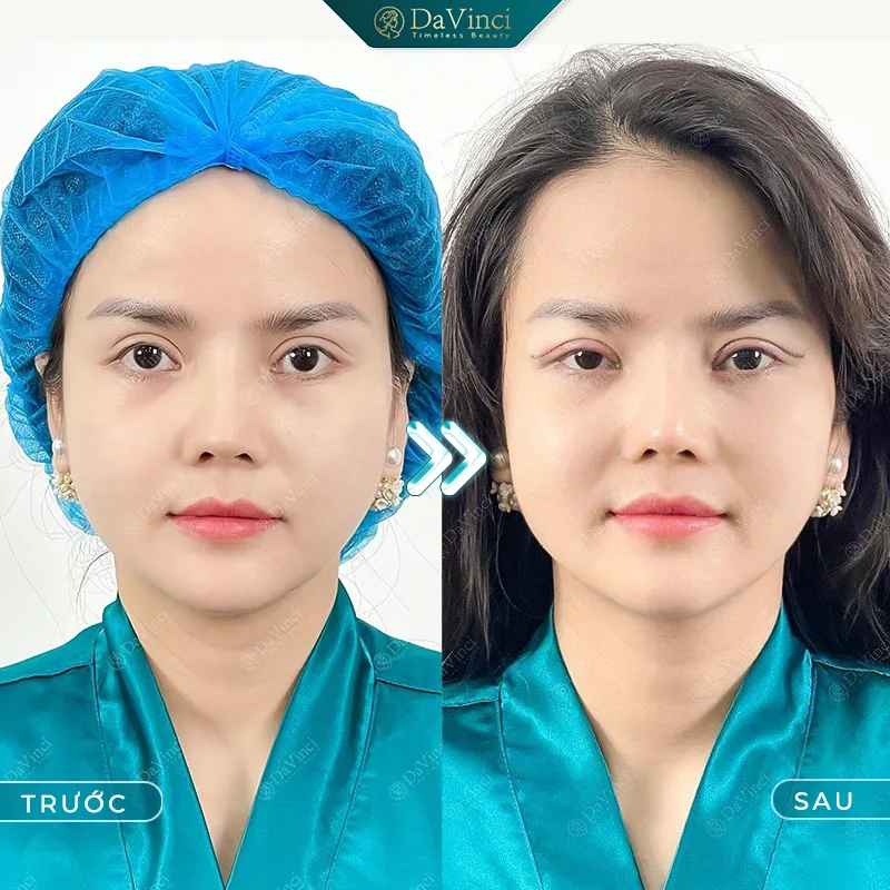Cắt mí bị sẹo trắng: Nguyên nhân và giải pháp khắc phục hiệu quả