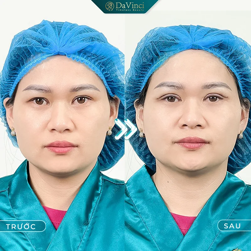 Cắt mí bị sẹo trắng: Nguyên nhân và giải pháp khắc phục hiệu quả