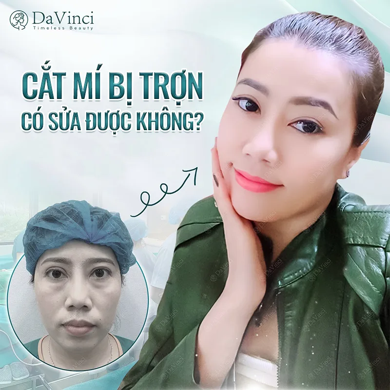 Cắt mí bị trợn phải làm sao? Phương pháp sửa mí mắt phẫu thuật hỏng Cắt mí bị trợn phải làm sao? Phương pháp sửa mí mắt phẫu thuật hỏng