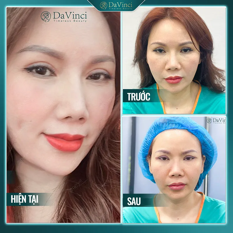 Cắt mí bị trợn phải làm sao? Phương pháp sửa mí mắt phẫu thuật hỏng Cắt mí bị trợn phải làm sao? Phương pháp sửa mí mắt phẫu thuật hỏng