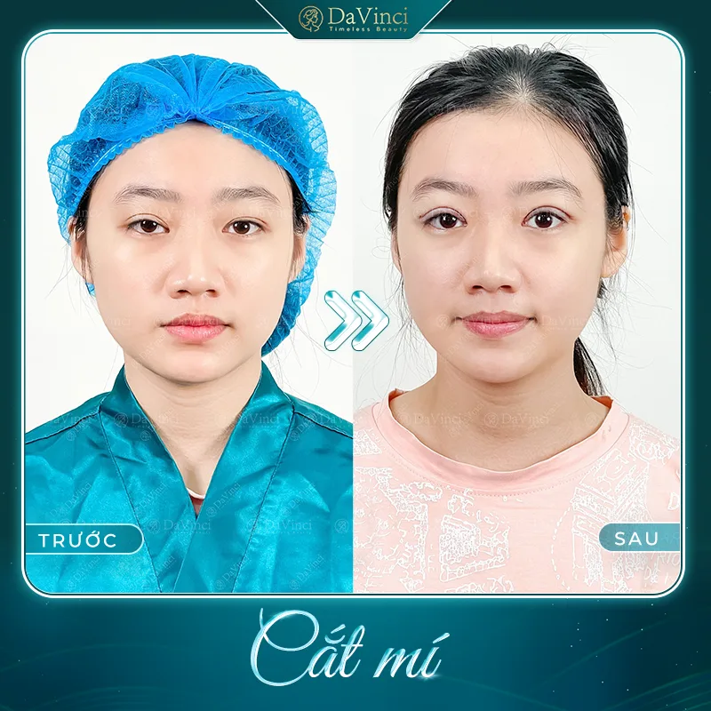 Cắt mí bị nhược cơ nâng mi ở đâu uy tín an toàn và đẹp tự nhiên? Cắt mí bị nhược cơ nâng mi ở đâu uy tín an toàn và đẹp tự nhiên?
