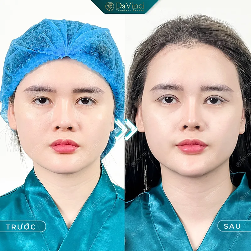 Nguyên nhân cắt mí hỏng? Tác hại của việc cắt mí hỏng