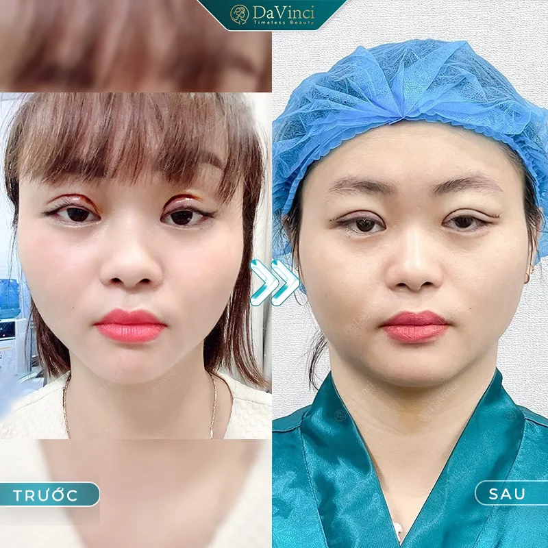 Nguyên nhân cắt mí hỏng? Tác hại của việc cắt mí hỏng