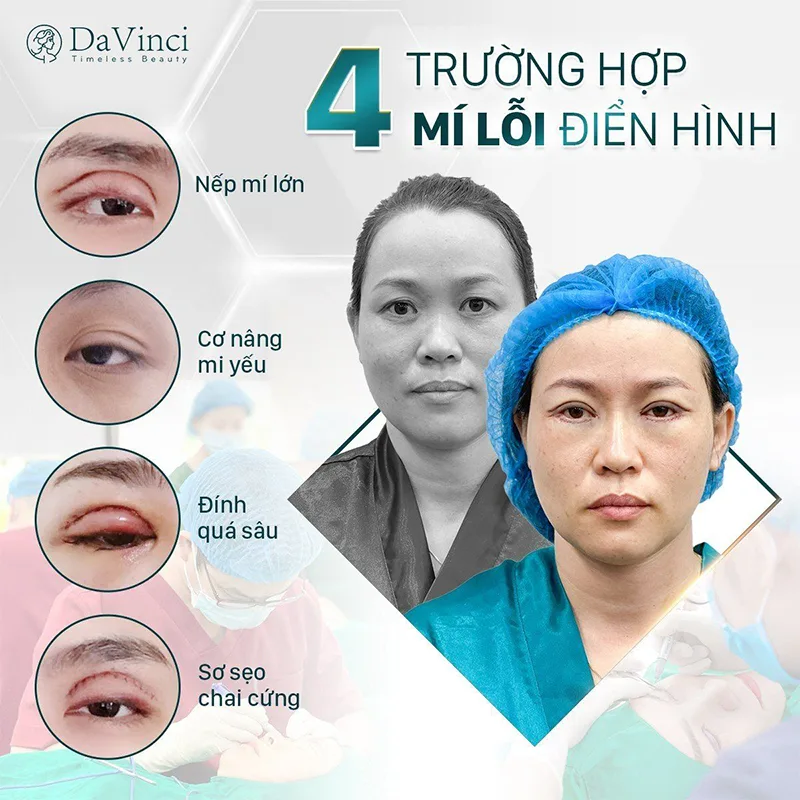 Nguyên nhân cắt mí hỏng? Tác hại của việc cắt mí hỏng