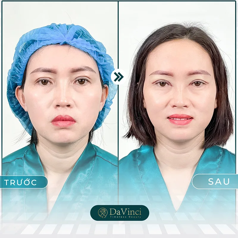 Nguyên nhân cắt mí hỏng là gì ? Cắt mí hỏng bao lâu sửa lại được?