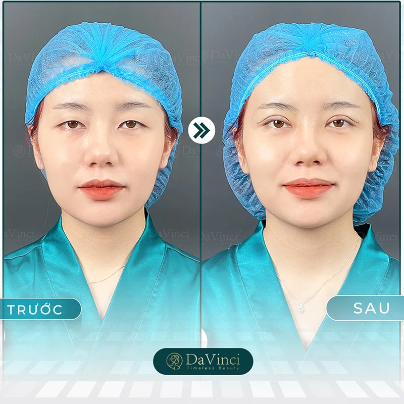 Trường hợp mắt một mí nên Cắt mí hay bấm mí tốt hơn?