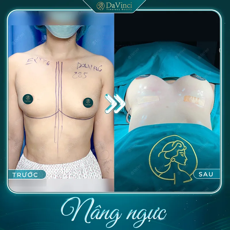 Túi ngực Motiva có tốt không? Giá bao nhiêu? Của nước nào? Túi ngực Motiva có tốt không? Giá bao nhiêu? Của nước nào?