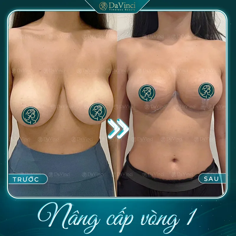 Treo sa trễ định tuyến sẹo mịn - Phương pháp nâng ngực chảy xệ an toàn Treo sa trễ định tuyến sẹo mịn - Phương pháp nâng ngực chảy xệ an toàn