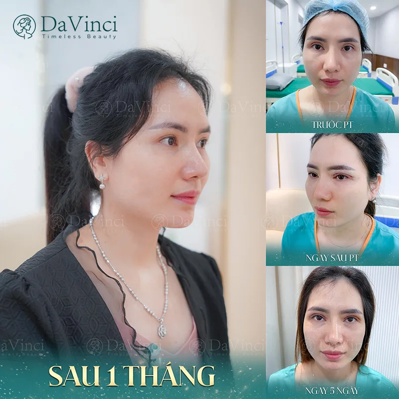 Cắt mí mắt có ăn được ốc không? Sau bao lâu thì ăn được? Cắt mí mắt có ăn được ốc không? Sau bao lâu thì ăn được?