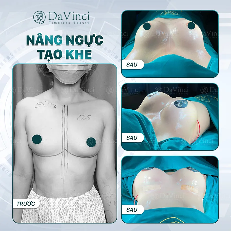Nâng ngực có ảnh hưởng đến sinh con? Nâng ngực có ảnh hưởng đến sinh con?
