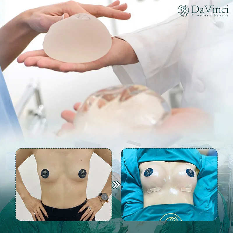 Ngực lép có nên nâng ngực không? Quy trình nâng ngực tại Davinci