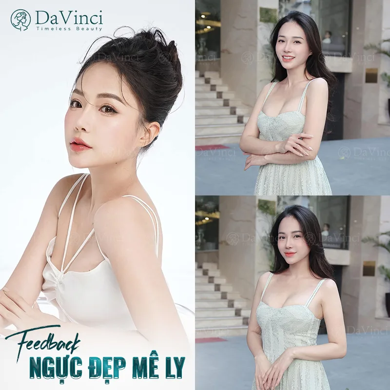 Phẫu thuật thu gọn ngực ở đâu tốt an toàn và đẹp tự nhiên?
