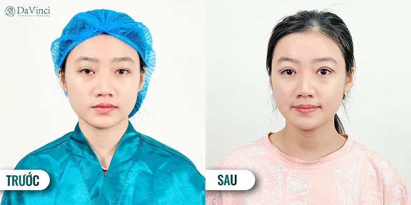 Cách massage mắt giảm sụp mí đơn giản hiệu quả tại nhà