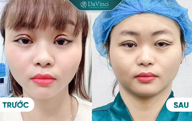 Cắt mắt size bao nhiêu đẹp tự nhiên? Nên lựa chọn cắt size mí 5,6,7 ,8 hay 9?