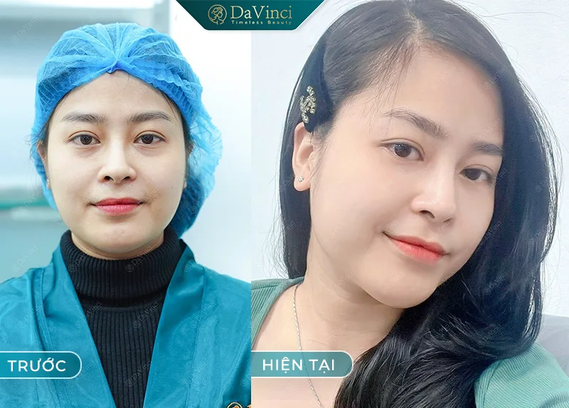 Lấy mỡ mí mắt trên bao nhiêu tiền? Bao lâu thì lành?