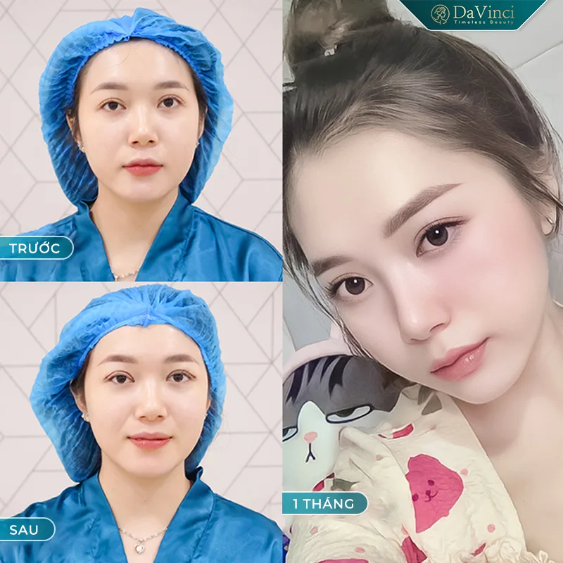Lấy mỡ mí mắt trên bao nhiêu tiền? Bao lâu thì lành?
