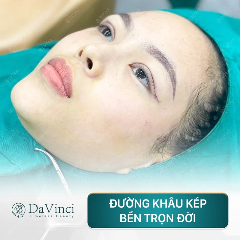 Lấy mỡ mí mắt trên bao nhiêu tiền? Bao lâu thì lành?