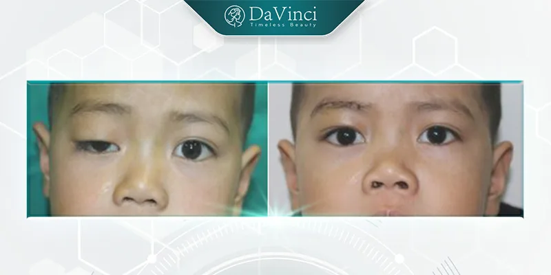 Sụp mí bẩm sinh có điều trị được hay không? Chi phí bao nhiêu? Sụp mí bẩm sinh có điều trị được hay không? Chi phí bao nhiêu?