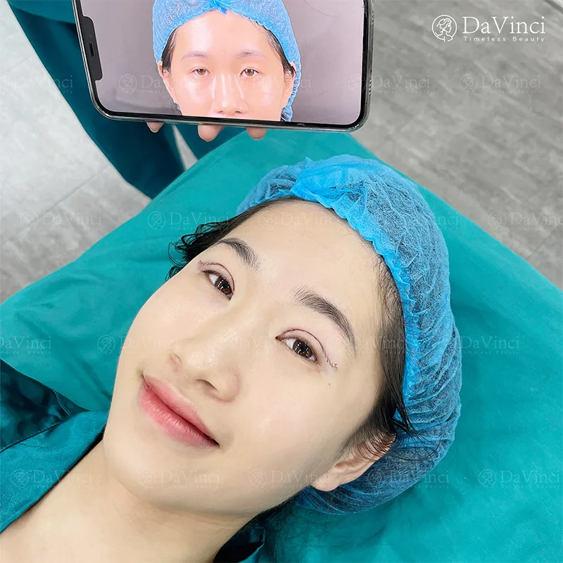 Cắt mí sau bao lâu sẽ vào form và có kết quả như mong đợi? Cắt mí sau bao lâu sẽ vào form và có kết quả như mong đợi?