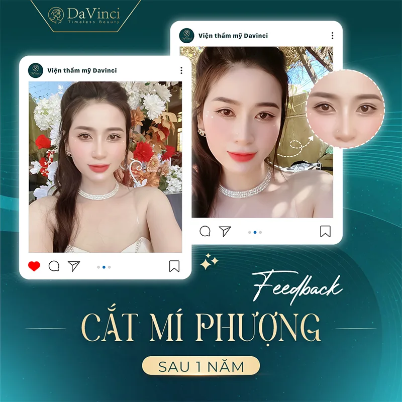 Cắt Mí Kiêng Nước Tương Bao Lâu? Lý Do Và Những Lưu Ý Quan Trọng Cắt Mí Kiêng Nước Tương Bao Lâu? Lý Do Và Những Lưu Ý Quan Trọng