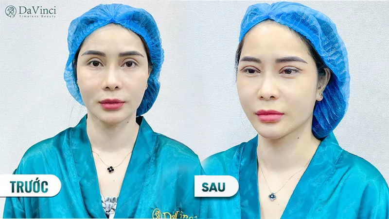 Lấy mỡ bọng mắt dưới bao lâu thì hết sưng? Cách chăm sóc hiệu quả