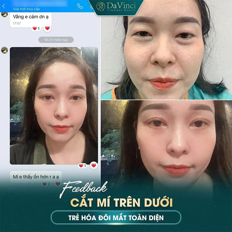 Lấy mỡ bọng mắt dưới bao lâu thì hết sưng? Cách chăm sóc hiệu quả