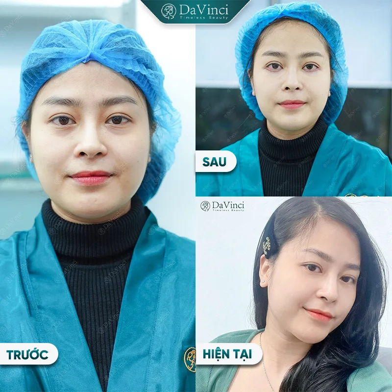 Lấy mỡ bọng mắt dưới bao lâu thì hết sưng? Cách chăm sóc hiệu quả