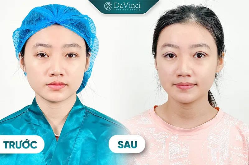 Nâng mí mắt sụp giá bao nhiêu? Giải pháp để mắt to tròn và tự nhiên