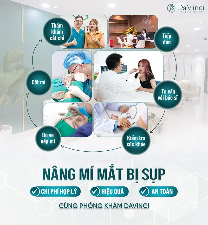 Nâng mí mắt sụp giá bao nhiêu? Giải pháp để mắt to tròn và tự nhiên