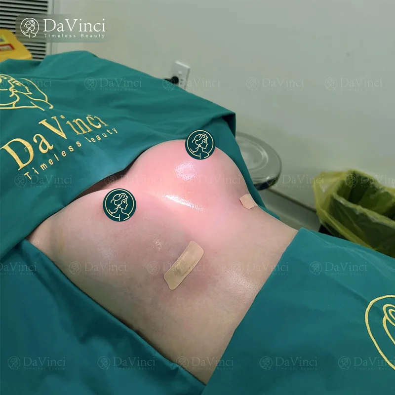 Nâng ngực bao lâu thì cắt chỉ? Quy trình và thời gian phục hồi chi tiết Nâng ngực bao lâu thì cắt chỉ? Quy trình và thời gian phục hồi chi tiết