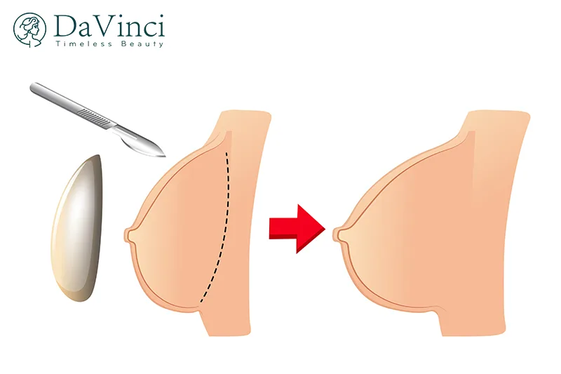 Nâng Ngực Có Ảnh Hưởng Đến Tuổi Thọ? Sự Thật Bạn Cần Biết