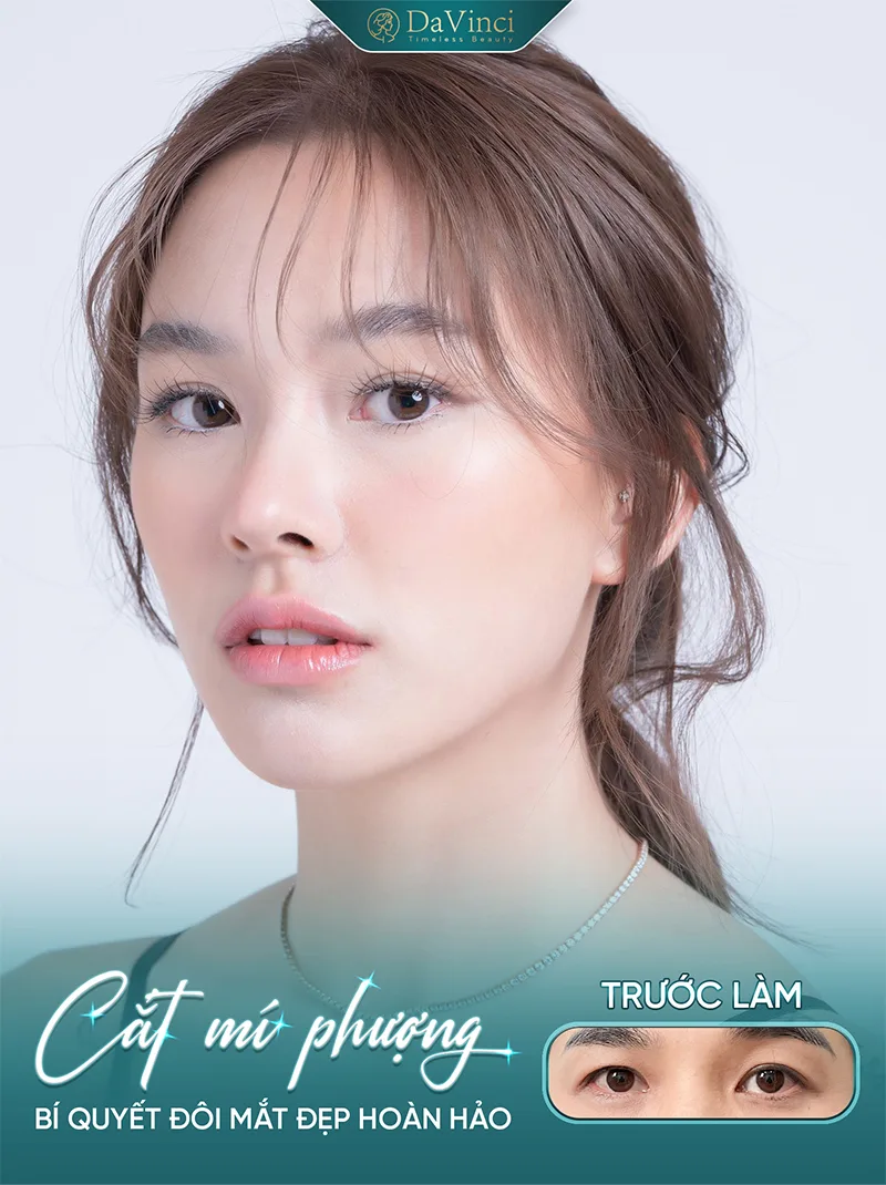 Nên cắt mí hay nâng cung mày? Tìm hiểu ưu nhược điểm 