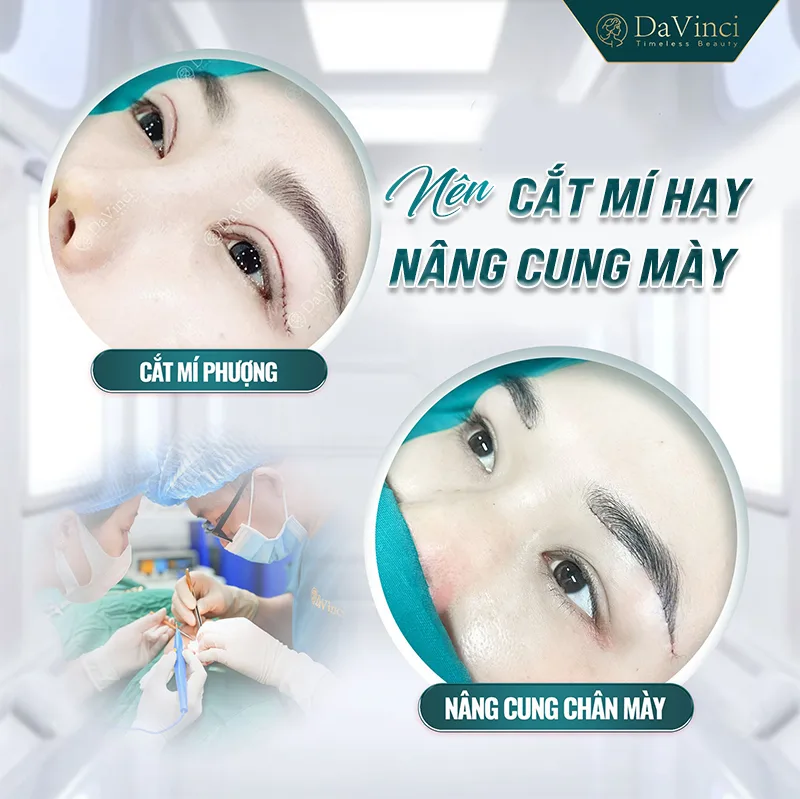 Nên cắt mí hay nâng cung mày? Tìm hiểu ưu nhược điểm 