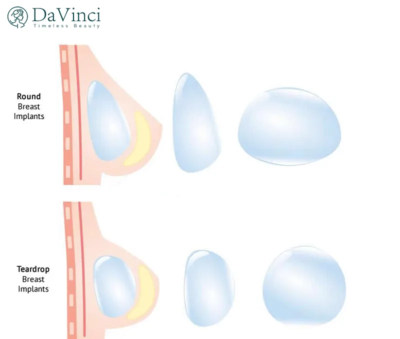 Nâng Ngực Túi Tròn Vs Túi Giọt Nước: Cái Nào Tốt Hơn? Nâng Ngực Túi Tròn Vs Túi Giọt Nước: Cái Nào Tốt Hơn?