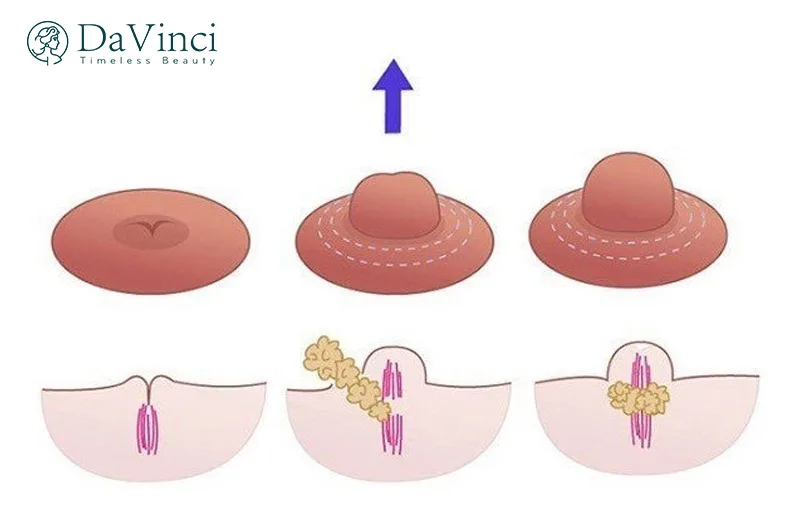 Phẫu Thuật Tụt Núm Vú Giá Bao Nhiêu? Tìm Hiểu Chi Phí Và Các Yếu Tố Ảnh Hưởng Phẫu Thuật Tụt Núm Vú Giá Bao Nhiêu? Tìm Hiểu Chi Phí Và Các Yếu Tố Ảnh Hưởng