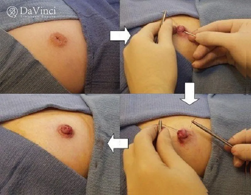 Phẫu Thuật Tụt Núm Vú Giá Bao Nhiêu? Tìm Hiểu Chi Phí Và Các Yếu Tố Ảnh Hưởng Phẫu Thuật Tụt Núm Vú Giá Bao Nhiêu? Tìm Hiểu Chi Phí Và Các Yếu Tố Ảnh Hưởng