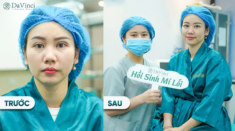 Cắt mí xong bị sưng? Bí quyết giúp giảm sưng nhanh và an toàn