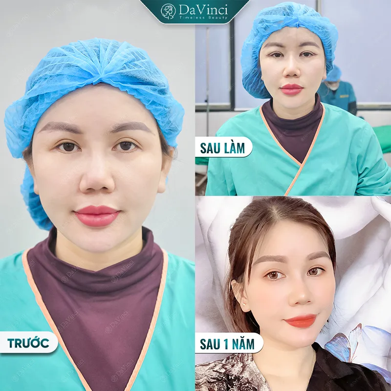 Cắt mí xong bị sưng? Bí quyết giúp giảm sưng nhanh và an toàn