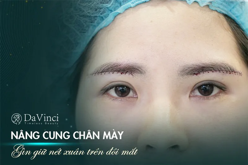 Treo mí mắt là gì? Giá bao nhiêu? Thực hiện ở đâu đẹp, uy tín?