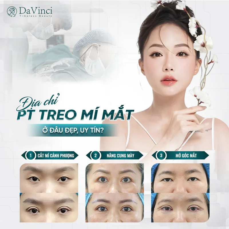Treo mí mắt là gì? Giá bao nhiêu? Thực hiện ở đâu đẹp, uy tín?