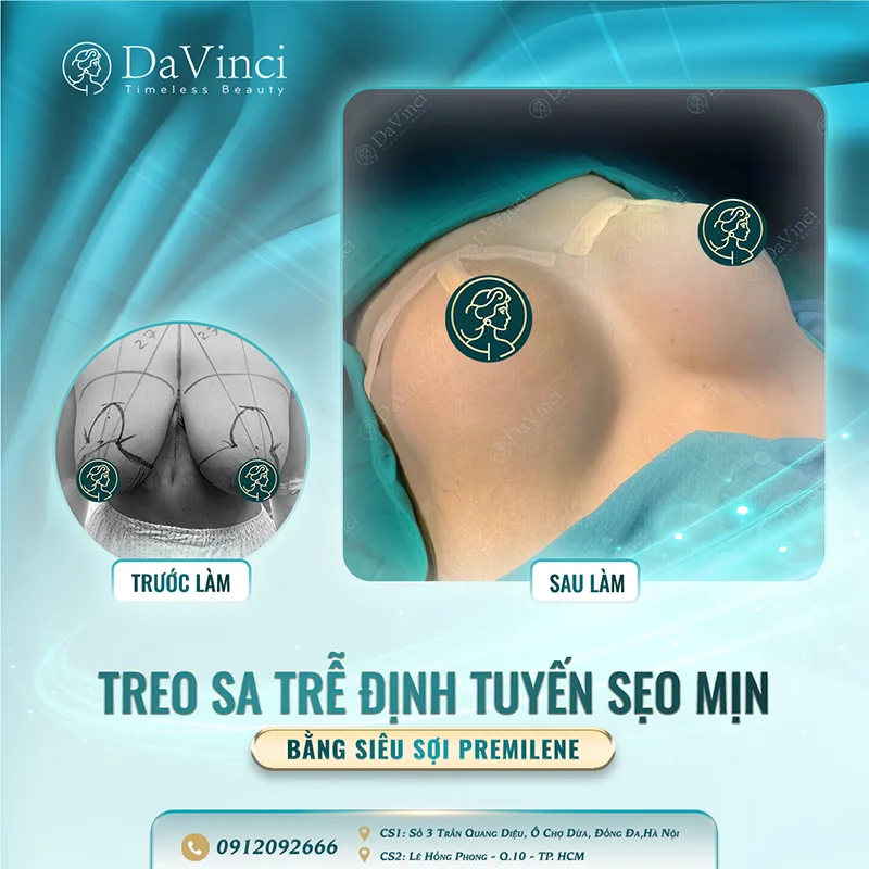Treo Sa Trễ Có Để Lại Sẹo Không? Sự Thật Bạn Cần Biết