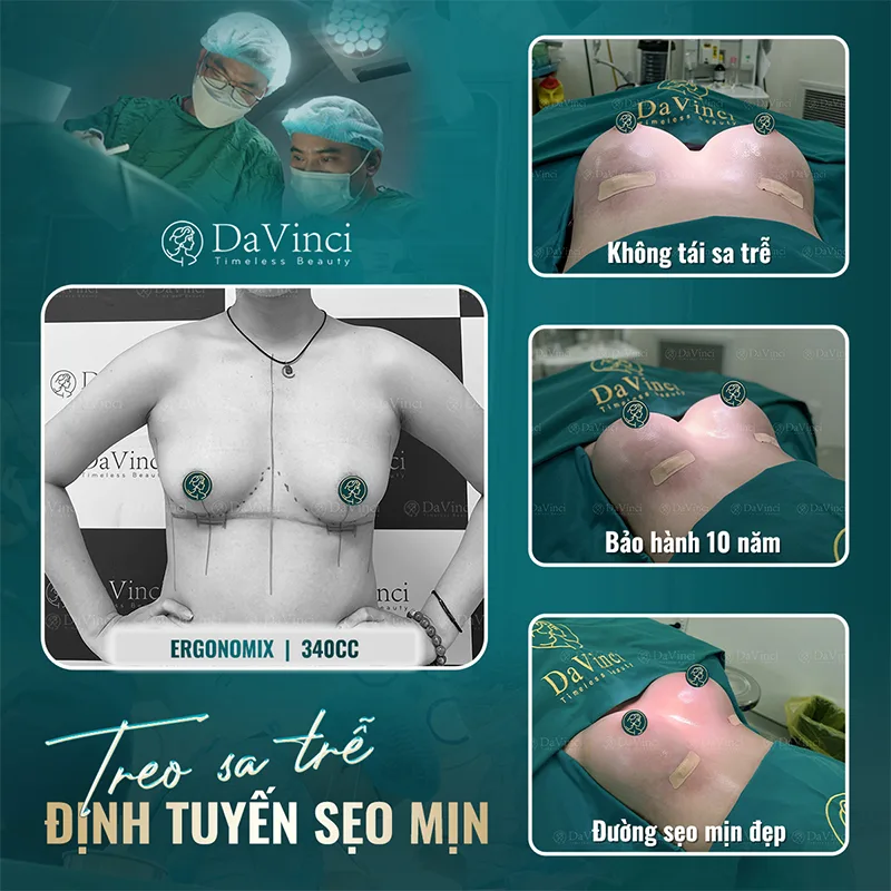 Treo Sa Trễ Đường Quầng Vú: Lợi Ích, Rủi Ro Và Quy Trình Phẫu Thuật Treo Sa Trễ Đường Quầng Vú: Lợi Ích, Rủi Ro Và Quy Trình Phẫu Thuật